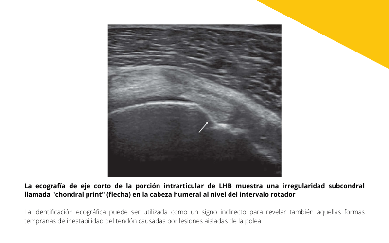 2. Ecografia Tendon largo biceps tempo formacion.png